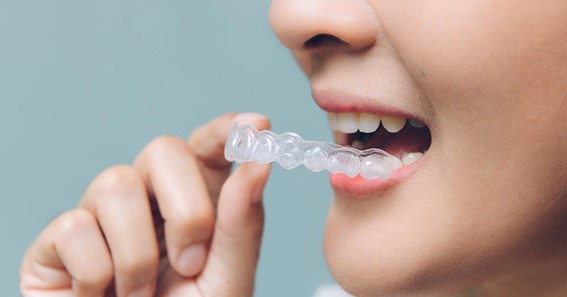 Why Is Invisalign A Good Option?